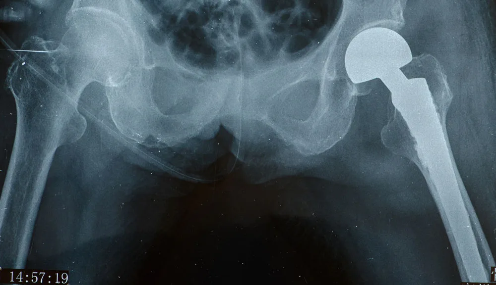 Osteoporose SitioVEG